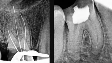 Management Of Separated Endodontic Instrument