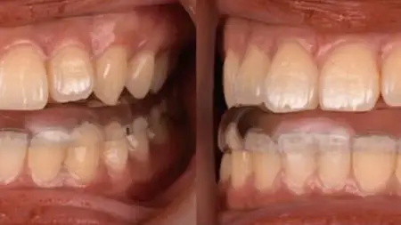 Digital Occlusal Economics