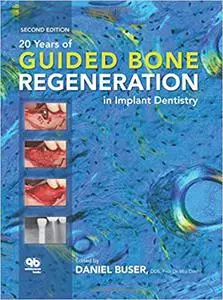 20 Years of Guided Bone Regeneration in Implant Denistry Ed 2