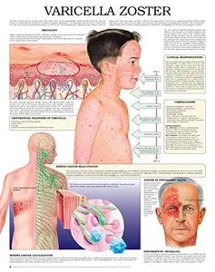 Varicella zoster e chart: Full illustrated