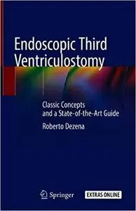 Endoscopic Third Ventriculostomy: Classic Concepts and a State-of-the-Art Guide