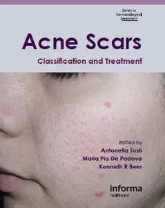 Acne Scars: Classification and Treatment (Series in Dermatological Treatment) by Antonella Tosti [Repost] 