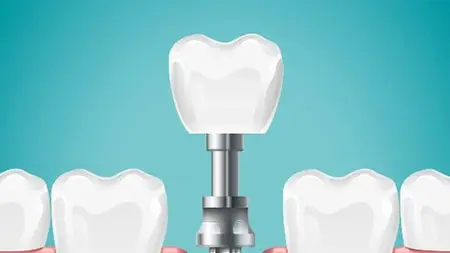 Dental Implants-An Esthetic Tooth Replacement