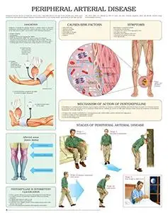 Peripheral arterial Disease e chart: Full illustrated