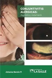 «Conjuntivitis alérgicas» by Johanna Garzón P.