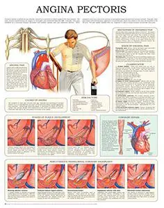 Angina pectoris e-chart: Quick reference guide