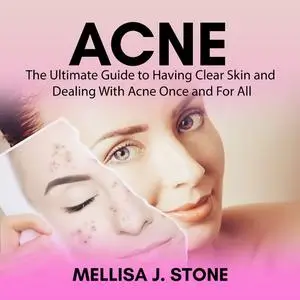 «Acne: The Ultimate Guide to Having Clear Skin and Dealing With Acne Once and For All» by Mellisa J. Stone