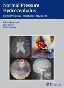 NPH - Normal Pressure Hydrocephalus: Pathophysiology - Diagnosis - Treatment [Repost]