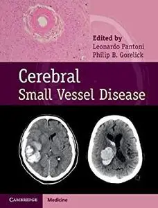 Cerebral Small Vessel Disease