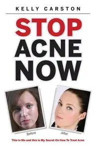 «Stop Acne Now: This Is Me and This Is My Secret On How to Treat Acne» by Kelly Carston