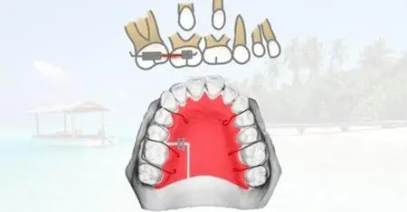 Orthodontic treatment of hypodontia and eruption problems