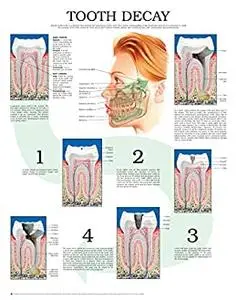 Tooth decay e chart: Full illustrated