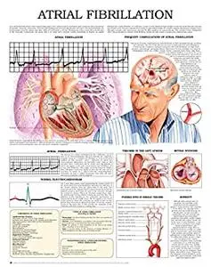 Atrial Fibrillation e chart: Full illustrated