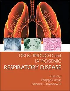 Drug induced and Iatrogenic Respiratory Disease