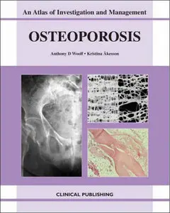 Osteoporosis: An Atlas Of Investigation And Diagnosis