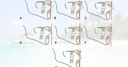 Orthodontic treatment in the transverse and sagittal planes