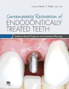 Contemporary Restoration of Endodontically Treated Teeth: Evidence-Based Diagnosis and Treatment Planning (repost)