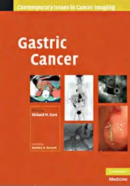 Gastric Cancer