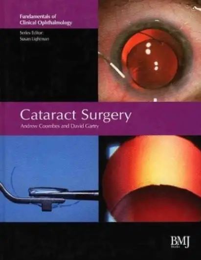Cataract Surgery