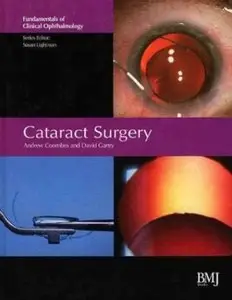 Cataract Surgery