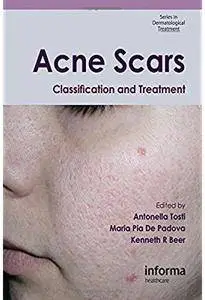 Acne Scars: Classification and Treatment [Repost]