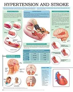 Hypertension and stroke e chart: Full illustrated