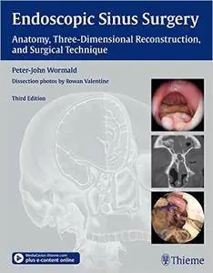 Endoscopic Sinus Surgery: Anatomy, Three-Dimensional Reconstruction, and Surgical Technique