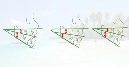 Early orthodontic treatment of dentoskeletal problems