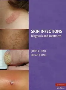 Skin Infections: Diagnosis and Treatment by Brian J. Hall