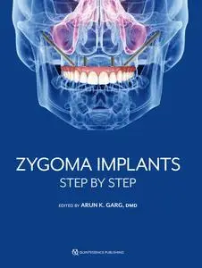 «Zygoma Implants» by Arun K. Garg