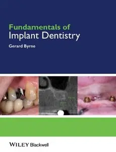 Fundamentals of Implant Dentistry (repost)