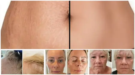 Advanced Microneedling Masterclass – Face, Body & Hairloss