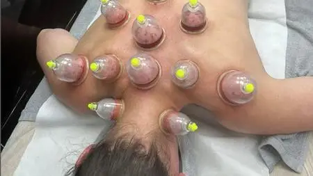 Professional Hijama And Dry Cupping Therapy Course