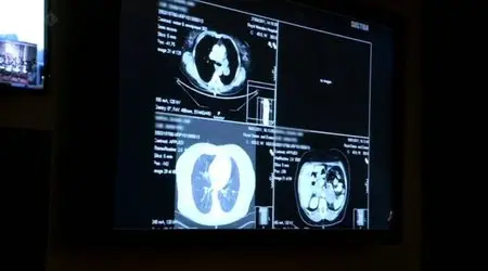 BBC Horizon - Defeating Cancer (2012)
