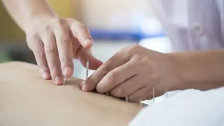 Acupuncture For Relieving Lower Back Pain And Sciatica