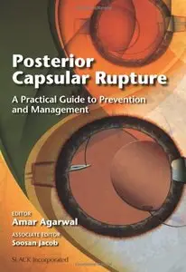 Posterior Capsular Rupture: A Practical Guide to Prevention and Management (repost)