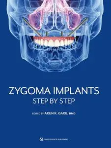 Zygoma Implants: Step by Step