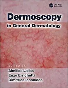 Dermoscopy in General Dermatology (Repost)