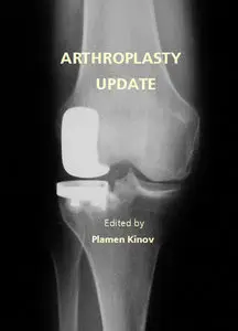 "Arthroplasty: Update" ed. by Plamen Kinov