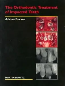 The Orthodontic Treatment of Impacted Teeth (repost)