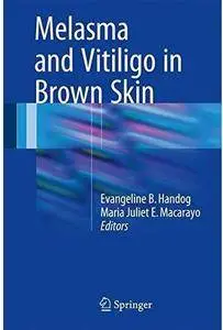Melasma and Vitiligo in Brown Skin [Repost]