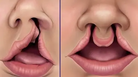 Cleft Lip And Palate- A Dental Deformity