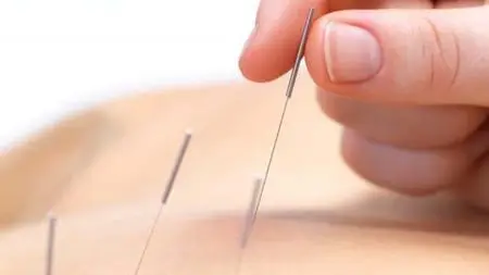 Dry Needling therapy for trigger points.