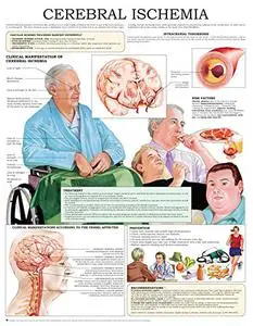 Cerebral ischemia e-chart: Quick reference guide