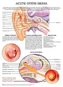 Acute otitis media e chart: Full illustrated