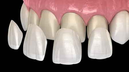 Dental Veneers- A Complete Guide To Perfect Smile
