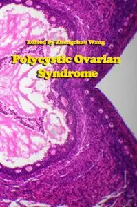 "Polycystic Ovarian Syndrome" ed. by Zhengchao Wang