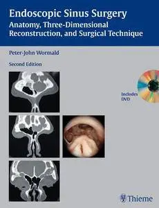 Endoscopic Sinus Surgery: Anatomy, Three-Dimensional Reconstruction, and Surgical Technique, 2 edition