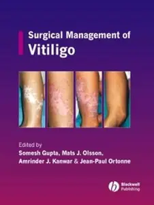 Surgical Management of Vitiligo