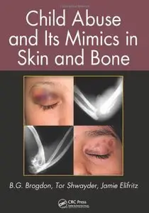 Child Abuse and its Mimics in Skin and Bone (repost)